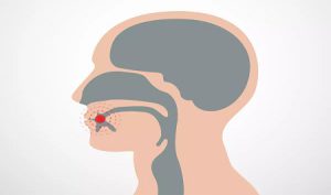 What Happens After Tongue Cancer Surgery?