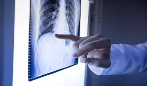 Bone Cancer and the Latest Advancements in Treatment