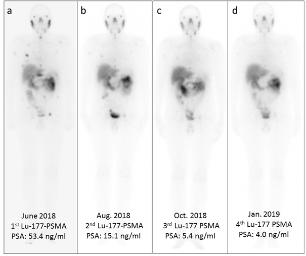 PEPTIDE RADIOLIGAND THERAPY