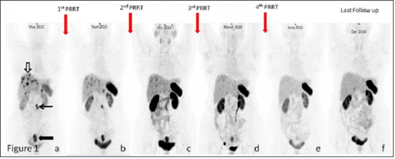 PEPTIDE RECEPTOR RADIONUCLIDE THERAPY