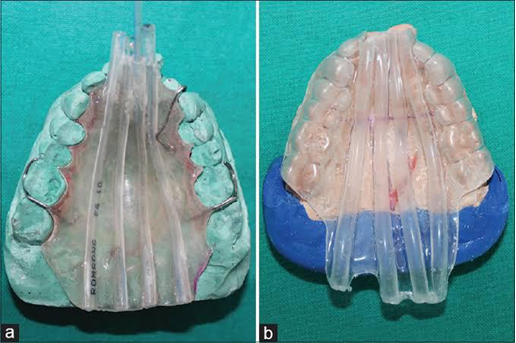 Brachytherapy molds